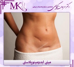 مینی ابدومینوپلاستی