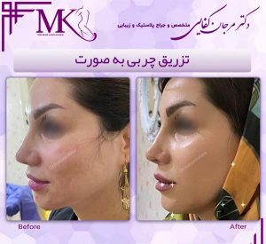 تزریق چربی
