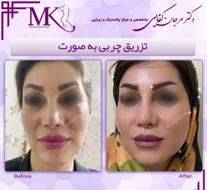 تزریق چربی