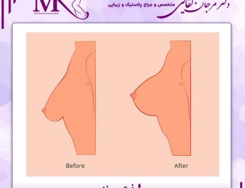 لیفت سینه در تهران ، معجزه زیبایی و سلامت