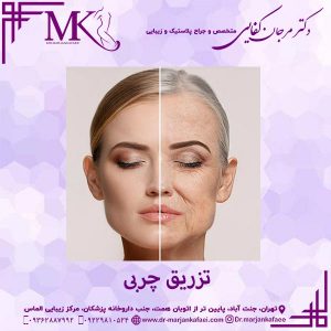 تزریق چربی در تهران