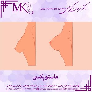 ماستوپکسی