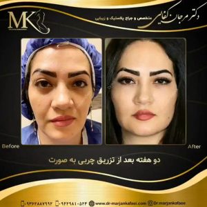 بهترین جراح تزریق چربی