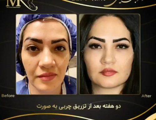 بهترین جراح تزریق چربی