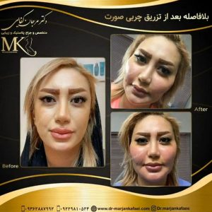 بهترین جراح تزریق چربی