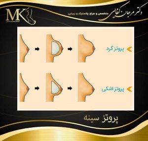 پروتز سینه
