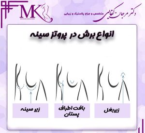 پروتز سینه-دکتر مرجان کفایی