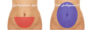 تفاوت مینی ابدومینوپلاستی با ابدومینوپلاستی کامل - دکتر مرجان کفائی