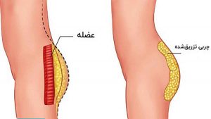 تزریق چربی باسن - مرجان کفائی