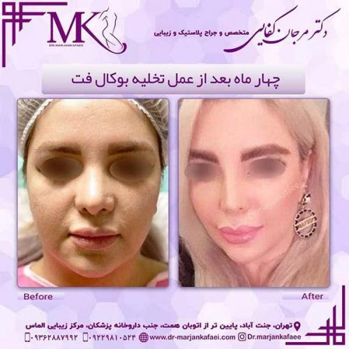 تخلیه-بوکال-فت-1