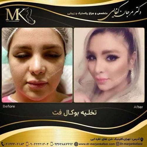 تخلیه-بوکال-فت-2